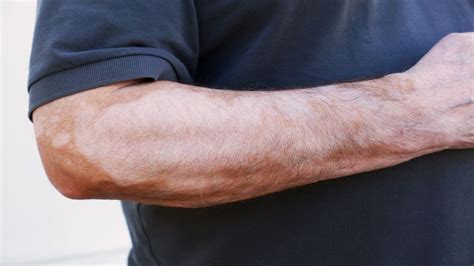 هل التينيا الملونة من الأمراض المعدية.. وكيفية علاجها نهائيًا؟