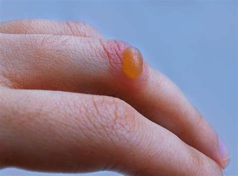 blisters meaning types  treatment skh academy