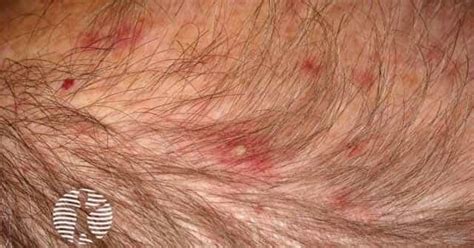 Scalp Folliculitis How To Cure Fungal Infection Pictures, Photos