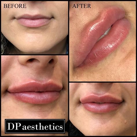 Lip Filler Before And After Top Lip | Before And After