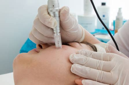 Dermapen – Nets Polyclinic