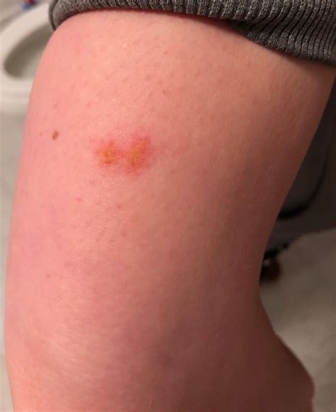 Feels like a bruise but not painful, on the back of my arm. Any advice