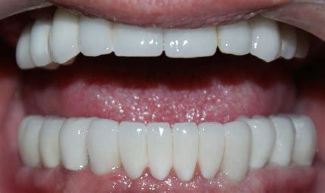 Top Tips to Improve Your Smile With an All-on-8 Dental Implants in