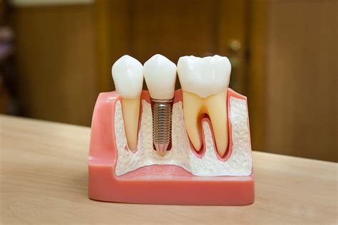 Синус-ліфтинг у Києві: ціна, гарантія - D.K. Dental Clinic