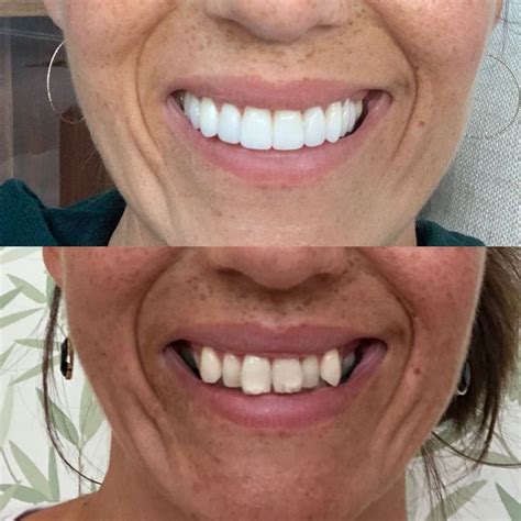veneers veneers teeth veneers cool sculpting