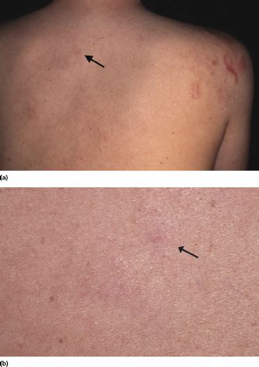 11: Cutaneous Follicle Center Lymphoma | Plastic Surgery Key