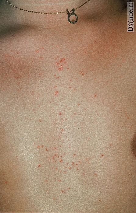 4-117-1 Steroid acne