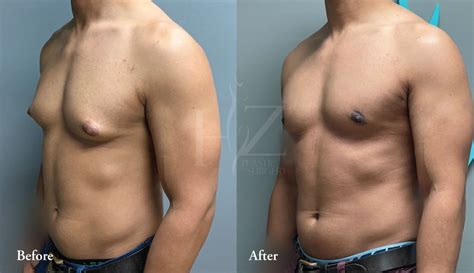 Gynecomastia Before & After — HZ Plastic Surgery