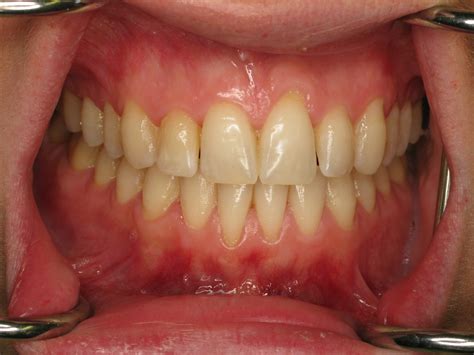 Connective Tissue Grafting Archives - Advanced Periodontics & Implant