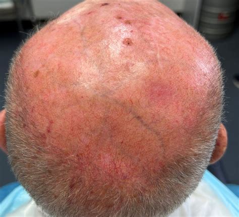 Scalp Skin Cancer: The Hidden Danger Hiding Under Your Hair