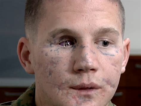 Marcus Luttrell Wounds