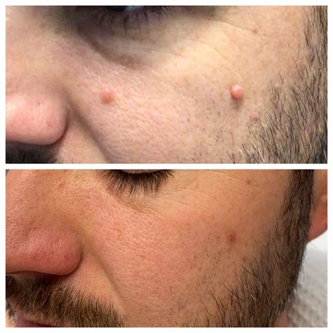 Shaved Mole Removal, [B&A] [Selfie] R/SkincareAddiction, 54% OFF