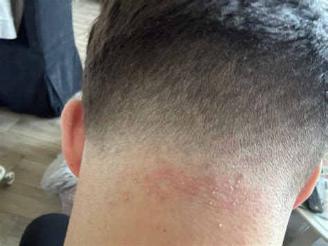 Was ist dieser Ausschlag nach einem Haarschnitt? (Haut, Friseur