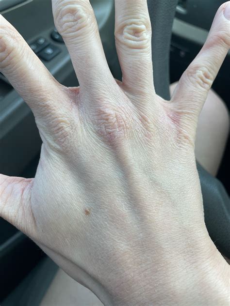 Chronic dry, red knuckles/tops of hands : r/Skincare_Addiction