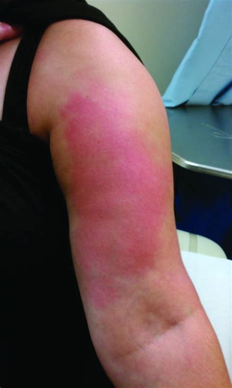 Systemic inflammatory reaction after pneumococcal vaccine: a case ...
