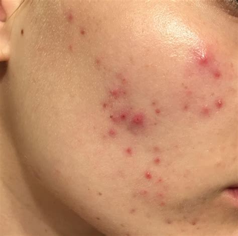 Rash 22 common skin rashes pictures causes treatment – Artofit