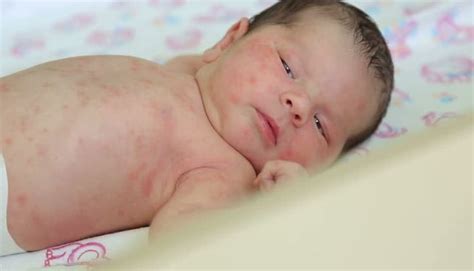 Waspada! Ini 6 Penyebab Alergi Kulit Pada Bayi Yang Sering Terjadi ...