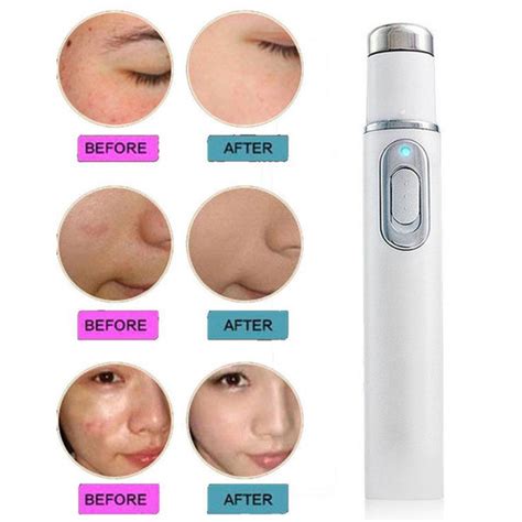 Revolutionary Skin & Nail Care - Anti-Fungal Laser Treatment | Inspire ...