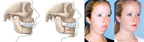 Corrective Jaw Surgery Sydney | Orthognathic Surgery