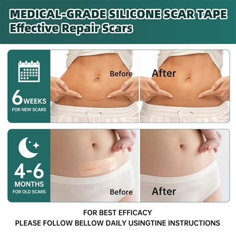 Fita De Silicone Para Cicatriz Antes E Depois - Fitas de Silicone para Cicatrizes: Redução Eficaz com Material Médico ...