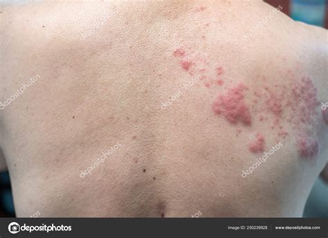 Telhas (Doença), Herpes zoster, vírus varicela-zoster. pele fotos ...