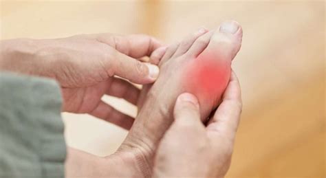 hyperuricemia guide  symptoms  control