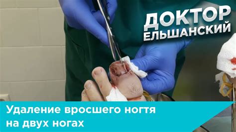 Удаление вросшего ногтя на двух ногах - YouTube