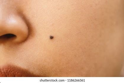 8,433 Face mole Images, Stock Photos & Vectors | Shutterstock