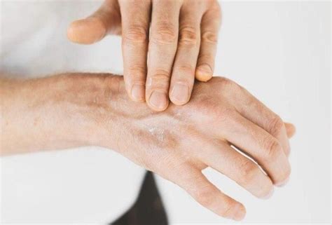 penyebab munculnya bintik bintik putih  kulit bukan melulu panu