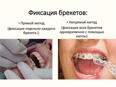 Фиксация брекетов - Арт Эстетика
