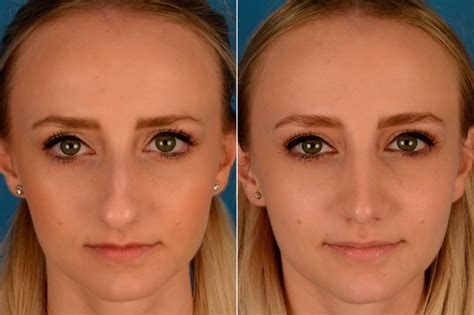 wear  rhinoplasty surgery  george buttenshaw blog