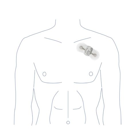 heart rhythm monitoring  birmingham heart rhythm group