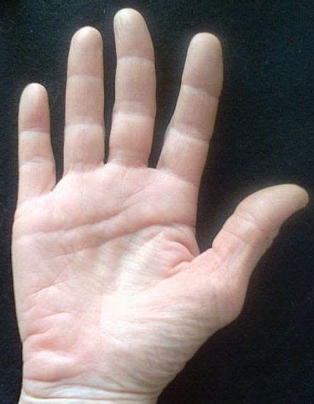 Middle Finger Is Crooked Symptoms that always occur with middle knuckle ...