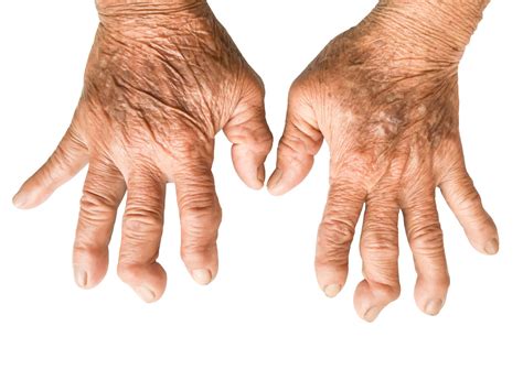 wide variation  characteristics  difficult  treat rheumatoid