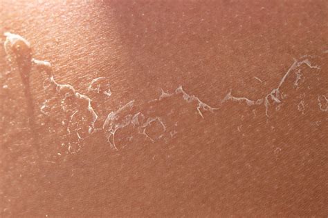 peeling skin  treatments  dermatology partners