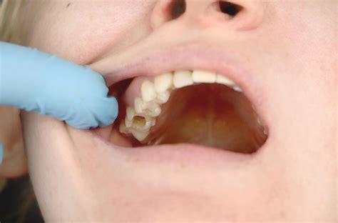 Reversing The Tides: 5-Step Blueprint To Saving Your Smile From Periodontal Disease