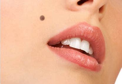 menghilangkan tompel tanda lahir  cepat  ampuh