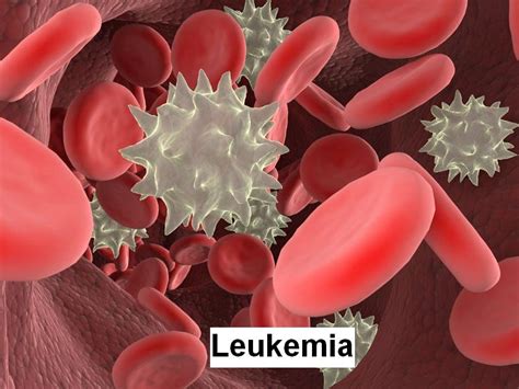Acute And Chronic Leukemia Symptoms, Diagnosis And Treatment | Health ...