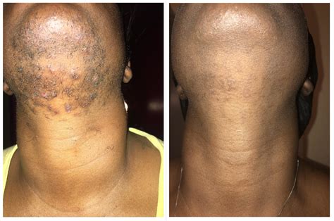 ZIO Patch Removal: Before Your Doctor Says So?
