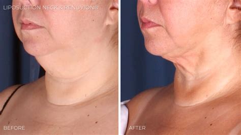 Neck Lift Alternatives: Surgical & Non-surgical Options | Omaha ...