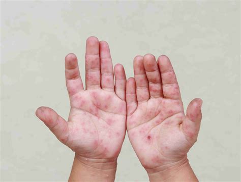 Contact Dermatitis | ClairéDerma