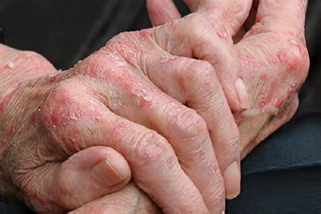 Мокнущая экзема на руках и ногах – причины, симптомы и лечение
