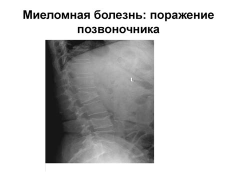 Миеломная болезнь (множественная миелома, болезнь Рустицкого-Калера ...