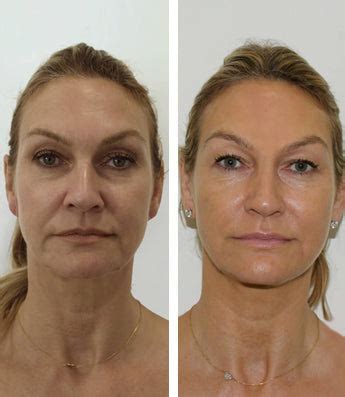 Get the best Face Thread Lift For the Face with 1mlSkin – 1ml Skin Clinic