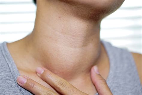 goiters abnormally large thyroid glands