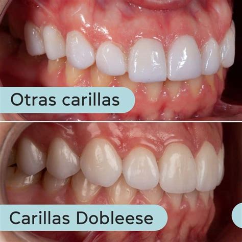 Carillas de Porcelana: qué son y características | Dobleese