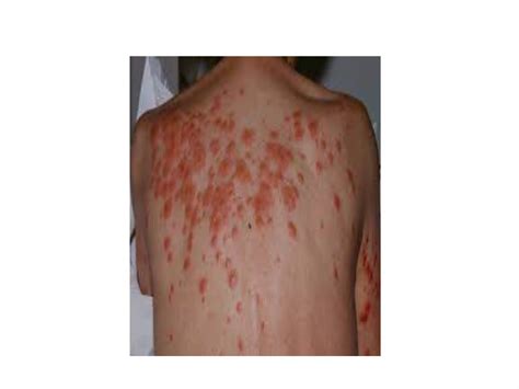 Paraneoplastic syndromes - CNS manifestations | PPT