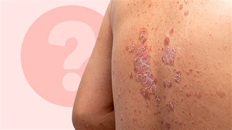 psoriasis  alcohol  reasons  drink