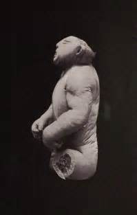 Anencephaly | Anatomy | Pinterest | Births