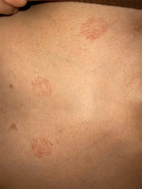 What are these red itchy and irritated and if I scratch it it hurts